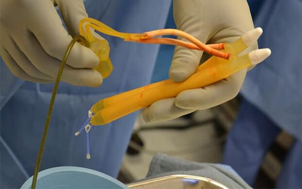 Implantati u penisu